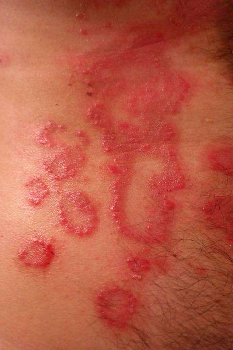castor oil and psoriasis