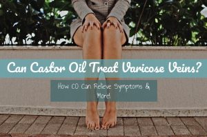 Can Castor Oil Treat Varicose Veins? | Castor Oil Guide