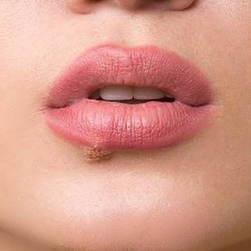 How to Use Castor Oil for Cold Sores 1