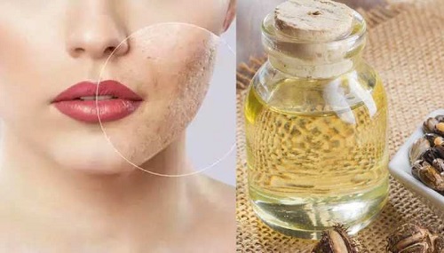 Castor Oil for Acne Scars | Benefits and Usage 2