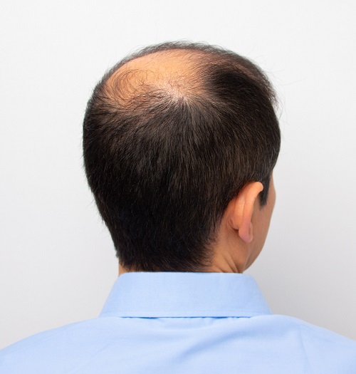Castor Oil Grow Hair On Bald Patches 1