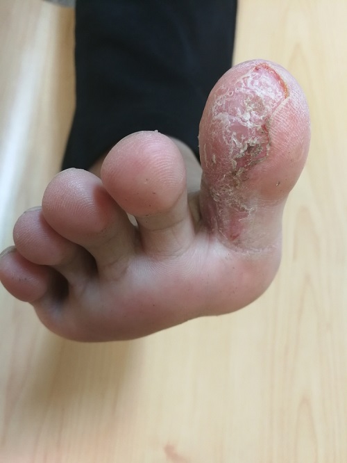 Essential Oils For Foot Fungus 1