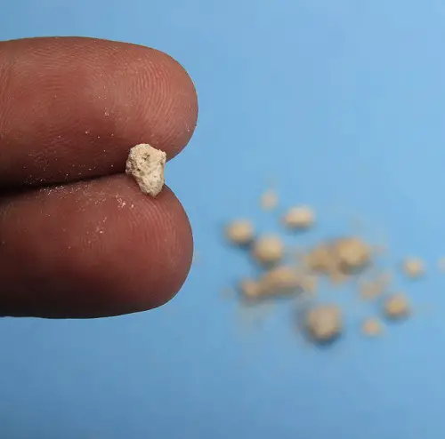 Does Drinking Beer Cause Kidney Stones