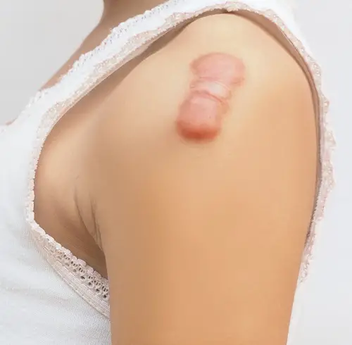 Does Vaseline Help Scars
