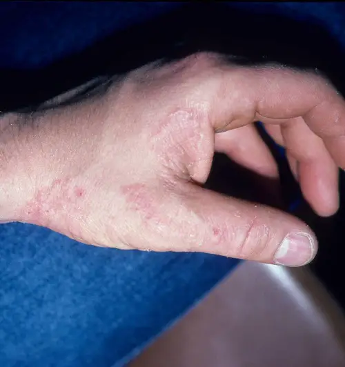 Can Help Treat Infections