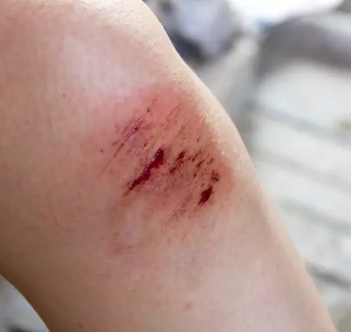 Vinegar For Wounds