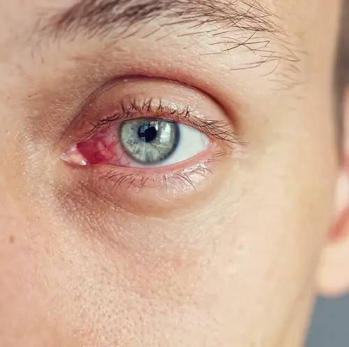 CASTOR OIL FOR DRY EYES