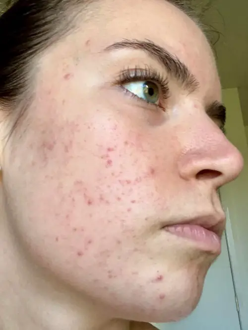 Treats Mild Acnes