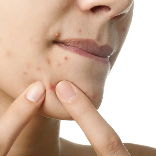 Reduces Acne