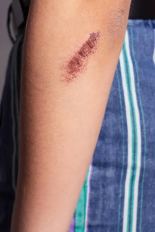 Wound healing