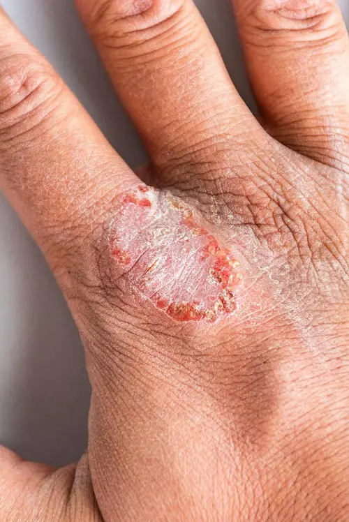 treating eczema