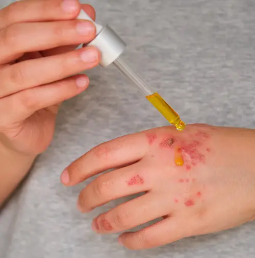 Relief From Skin Issues 1