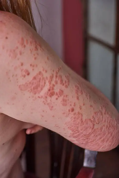 Castor Oil for Psoriasis