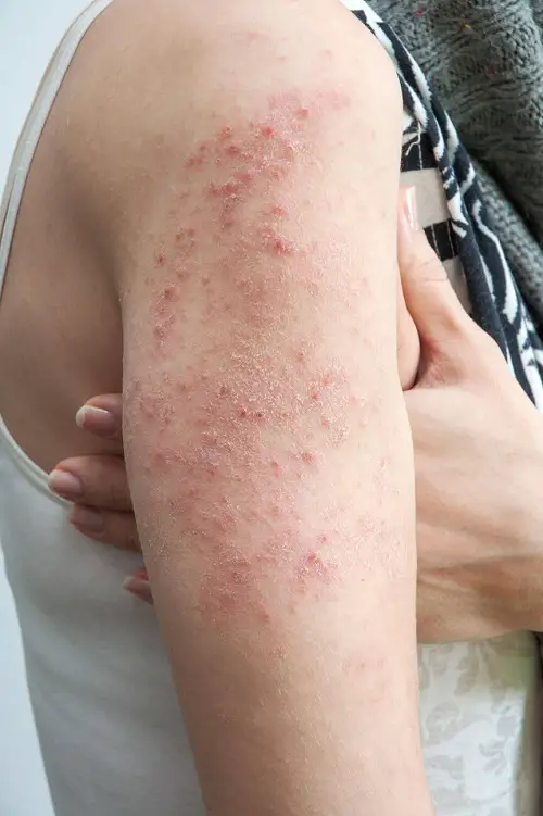 allergic reactions