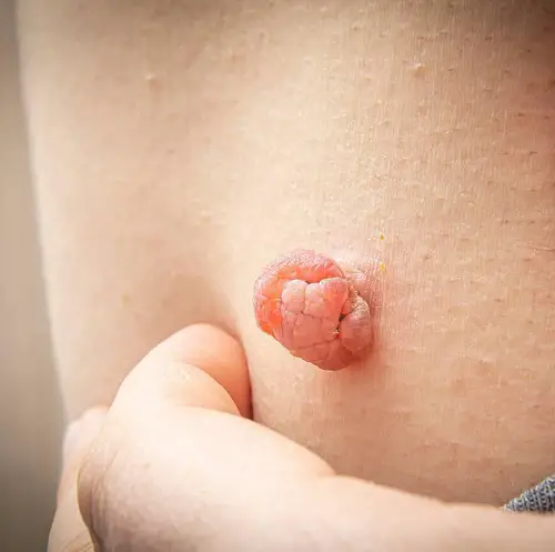 Skin Tags