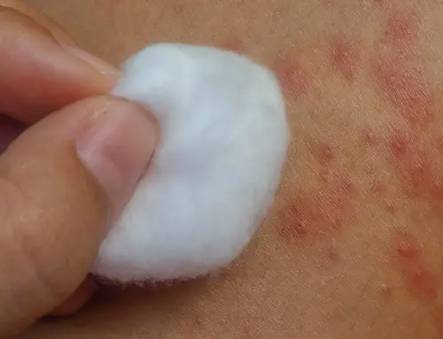 Use Castor Oil for Psoriasis