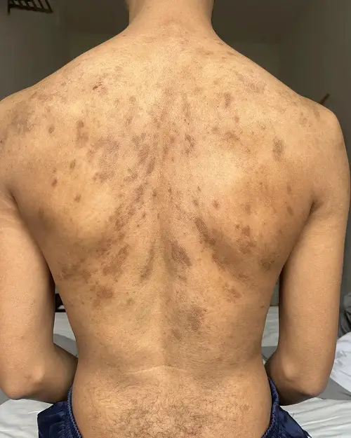 Back fungal Infection