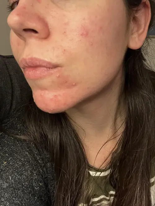 How To Treat Castor Oil Allergic Reaction