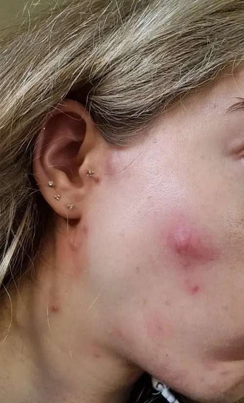 Healing Time For a Cyst