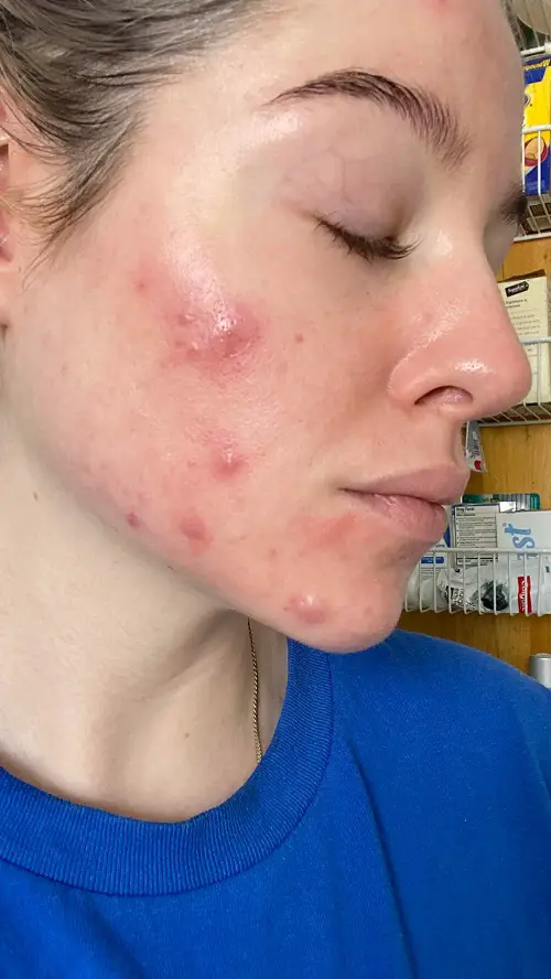 Healing Cysts Naturally with Tea Tree Oil 11
