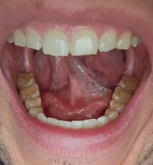 Erode Teeth