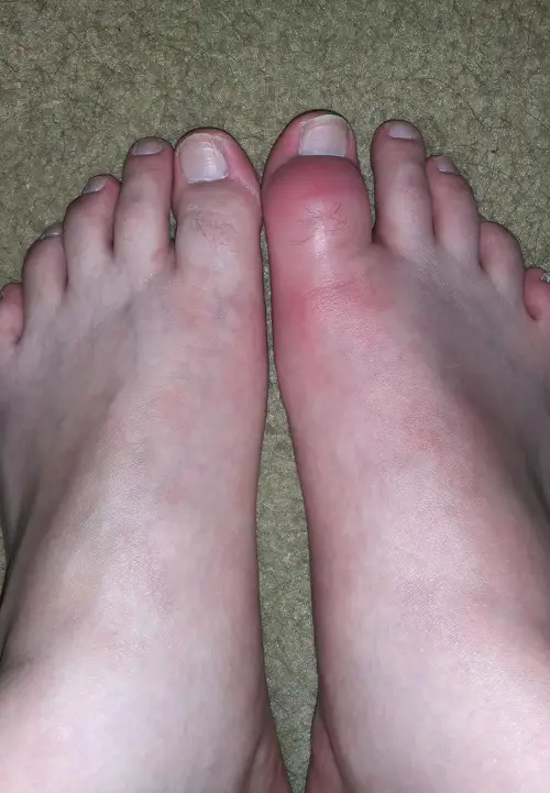 Castor Oil For Gout
