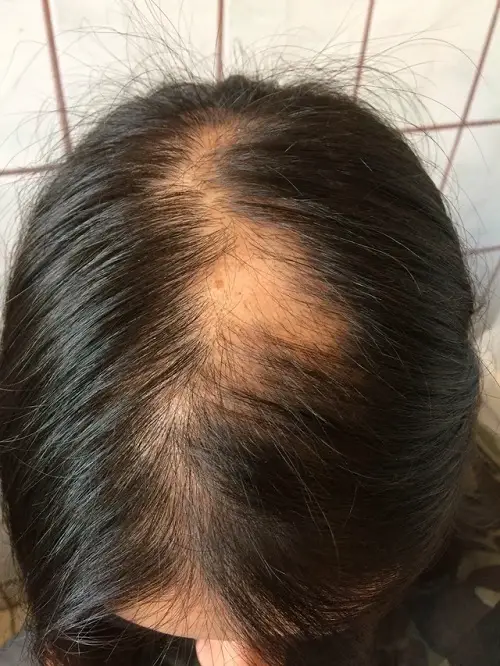 Hair Loss