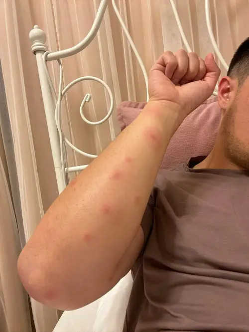 Essential Oils For Insect Bites 