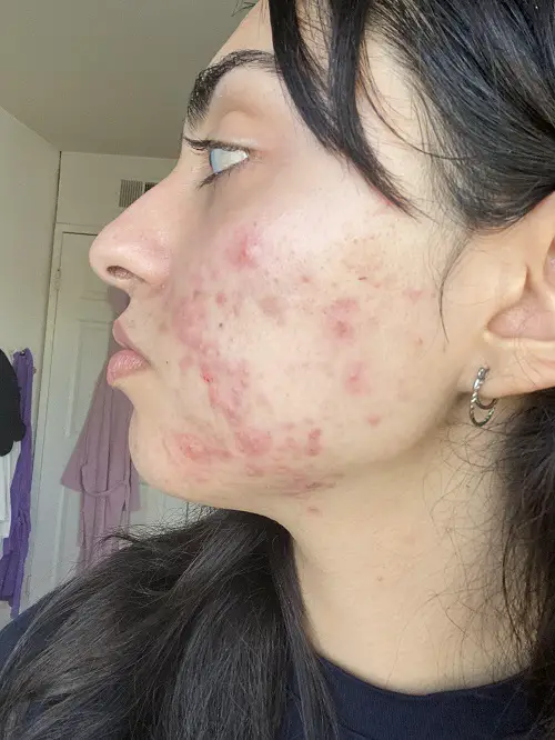 Help Soothe Sunburn and Acne