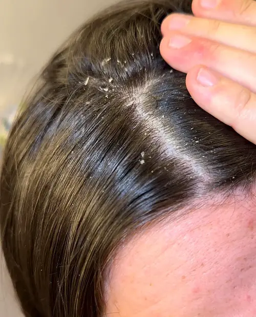 Dandruff Remedy