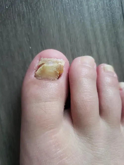 Cure Nail Fungus