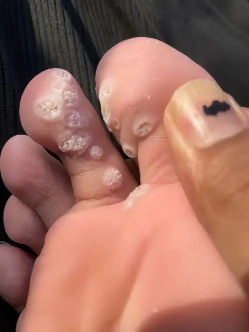Gets Rid of Warts and Moles