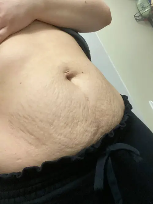 Oils That Can Fade Stretch Marks and Scars Faster Than You Think 1