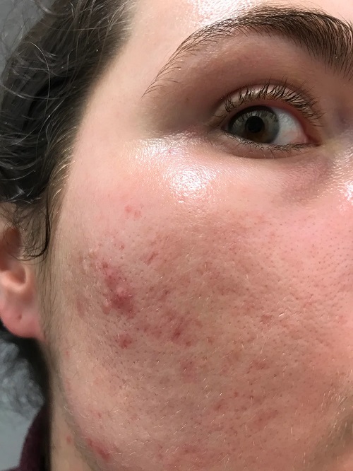 Clogging Pores