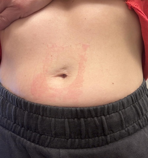 Benefits of Castor Oil Patch for Belly Button
